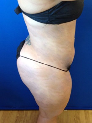 Liposuction