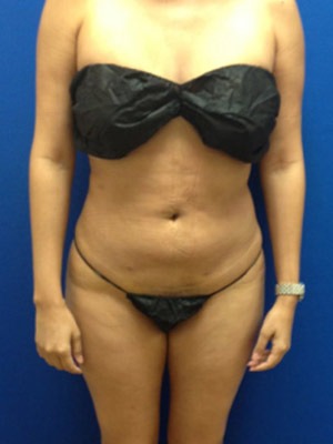 Liposuction