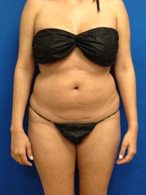 Liposuction