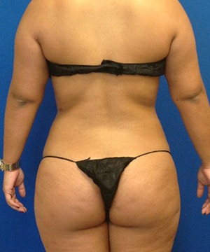 Liposuction