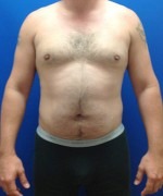 Liposuction