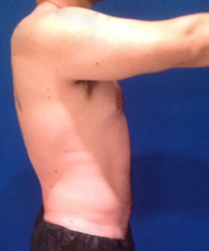 Liposuction