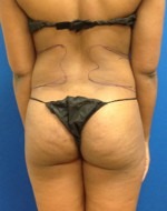 Liposuction