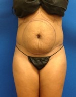 Liposuction