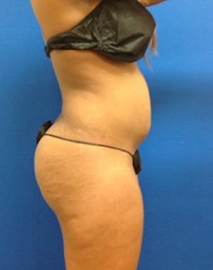 Liposuction