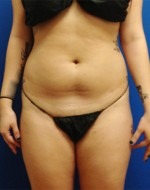 Liposuction