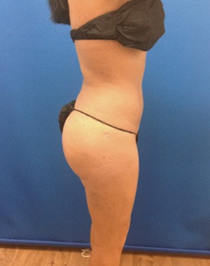 Liposuction