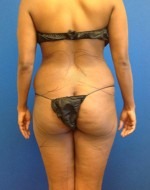 Liposuction