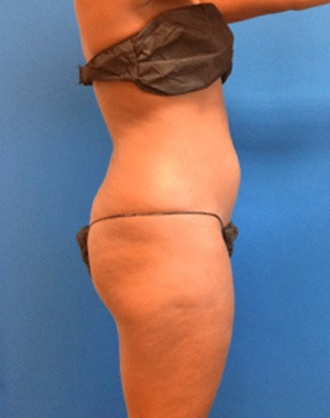 Liposuction