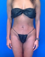 Liposuction