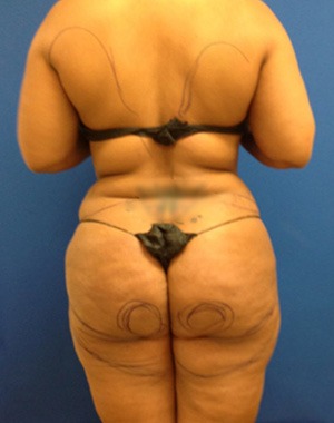 Liposuction