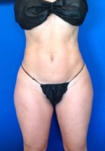 Liposuction