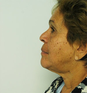 Face & Neck Rejuvenation