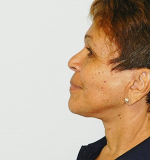 Face & Neck Rejuvenation