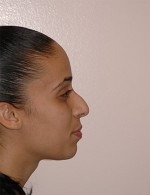 Nose Reshaping