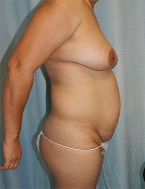 Liposuction