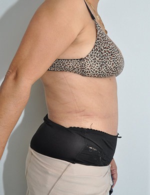 Liposuction