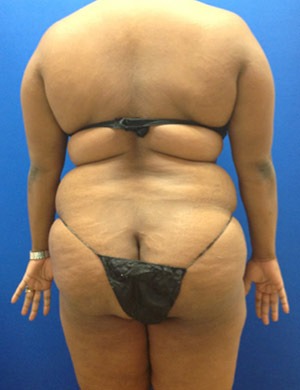 Liposuction