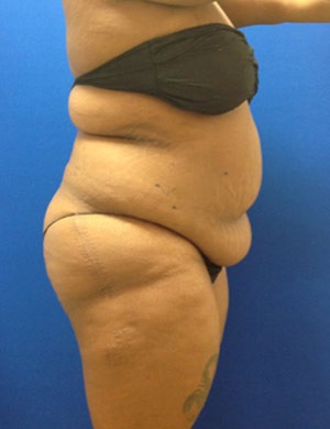 Liposuction