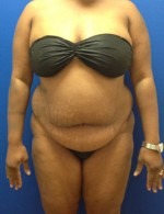 Liposuction