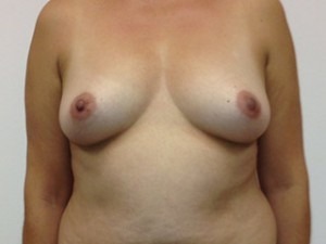 Breast Augmentation