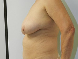 Breast Lift