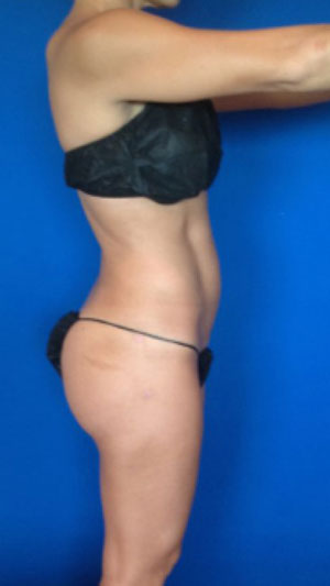 Liposuction