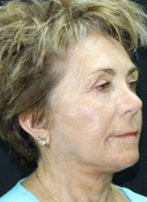 Face & Neck Rejuvenation