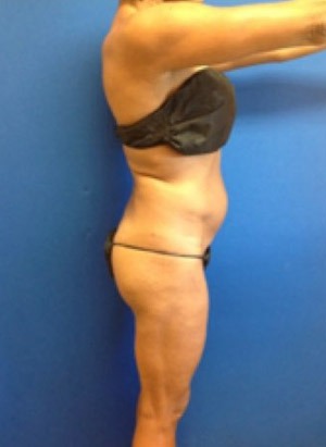 Liposuction