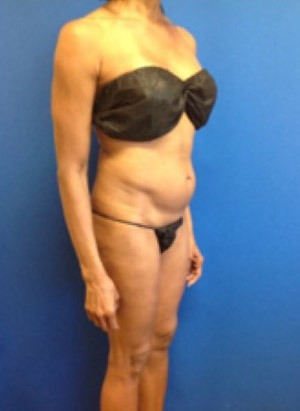 Liposuction