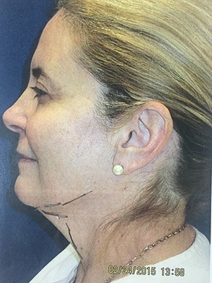 Face & Neck Rejuvenation