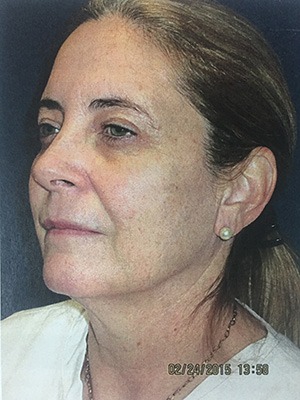 Face & Neck Rejuvenation