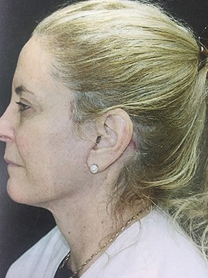 Face & Neck Rejuvenation