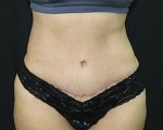 Tummy Tuck