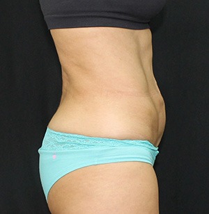 Tummy Tuck