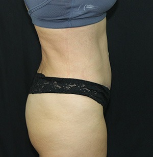 Tummy Tuck