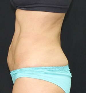 Tummy Tuck