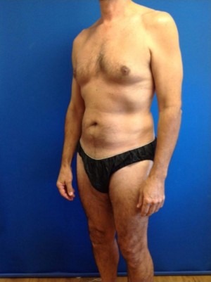 Gynecomastia