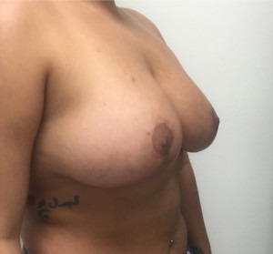 Breast Augmentation