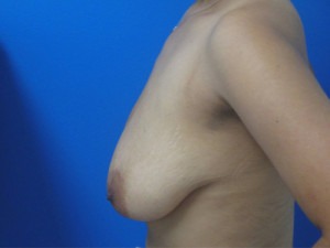 Breast Augmentation