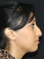 Nose Reshaping