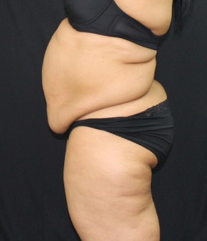 Liposuction