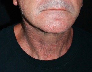 Face & Neck Rejuvenation