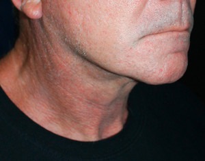 Face & Neck Rejuvenation