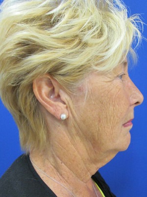 Face & Neck Rejuvenation