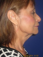 Face & Neck Rejuvenation