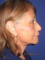 Face & Neck Rejuvenation