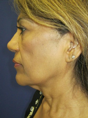 Face & Neck Rejuvenation