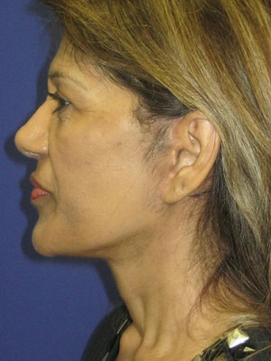 Face & Neck Rejuvenation