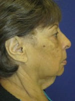 Face & Neck Rejuvenation